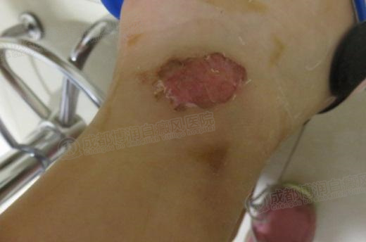 表皮移植治疗”基金援助火热征集中! 表皮移植治疗”基金援助火热征集中!